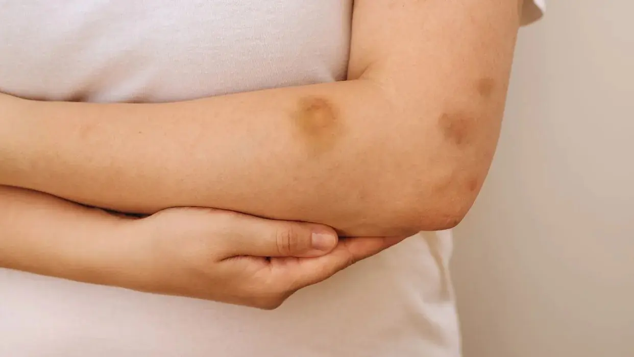 Doctors Urge: Don’t Ignore Unexplained Bruising — These Hidden Reasons Could Be the Cause
