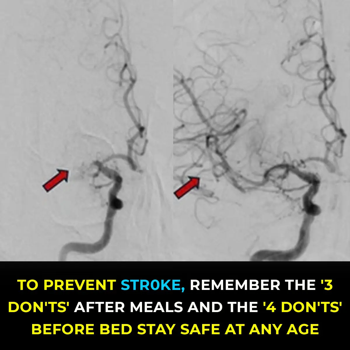 Preventing Stroke At Any Age: 3 “Don’ts” After Meals—And 4 “Don’ts” Before Bed