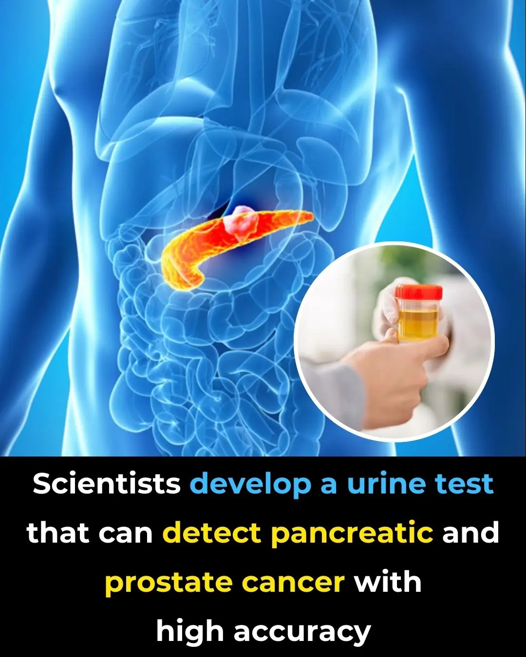 Scientists Develop a Urine Test That Can Detect Pancreatic and Prostate Cancer With High Accuracy