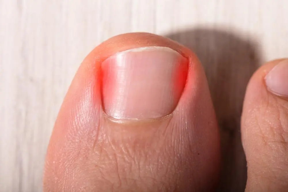 Home Remedies to Get Rid Of Ingrown Toenails (Onychocryptosis)