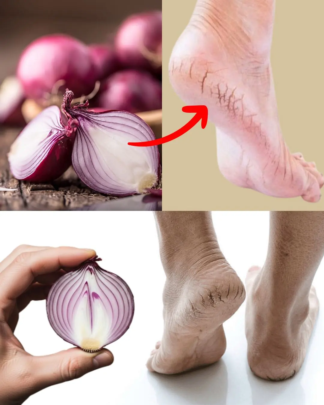 How to Use Onions to Heal Cracked Heels at Home