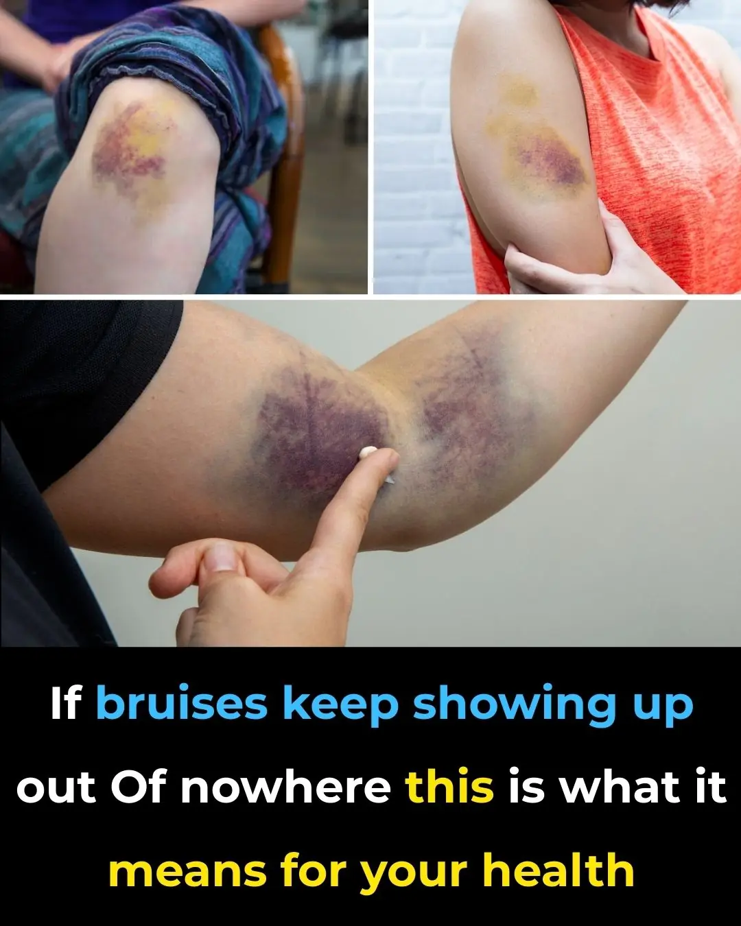 Unexplained Bruising on Your Body: Causes and Treatments