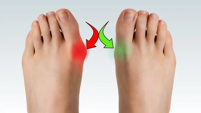 Reverse Bunion Pain with These Simple Home Remedies