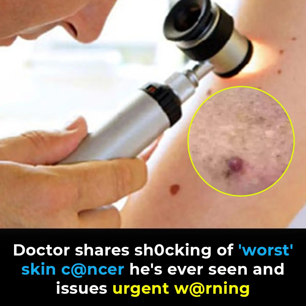 Doctor shares sh0cking of 'worst' skin c@ncer he's ever seen and issues urgent w@rning