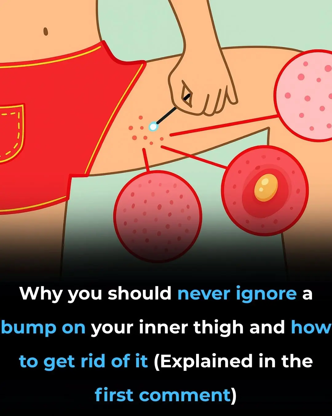The Most Effective Ways to Get Rid of Bumps on Inner Thigh (Backed by Science)