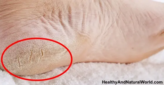 How to Get Rid of Dead Dry Skin on Feet