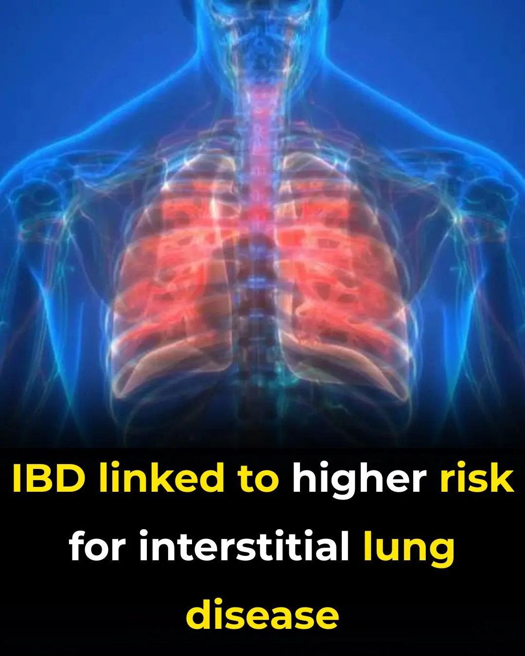 IBD Linked to Higher Risk for Interstitial Lung Disease