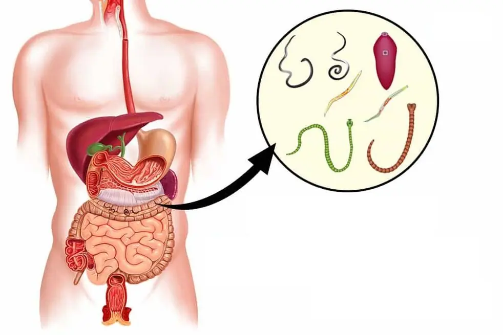 How to Get Rid of Worms in Humans