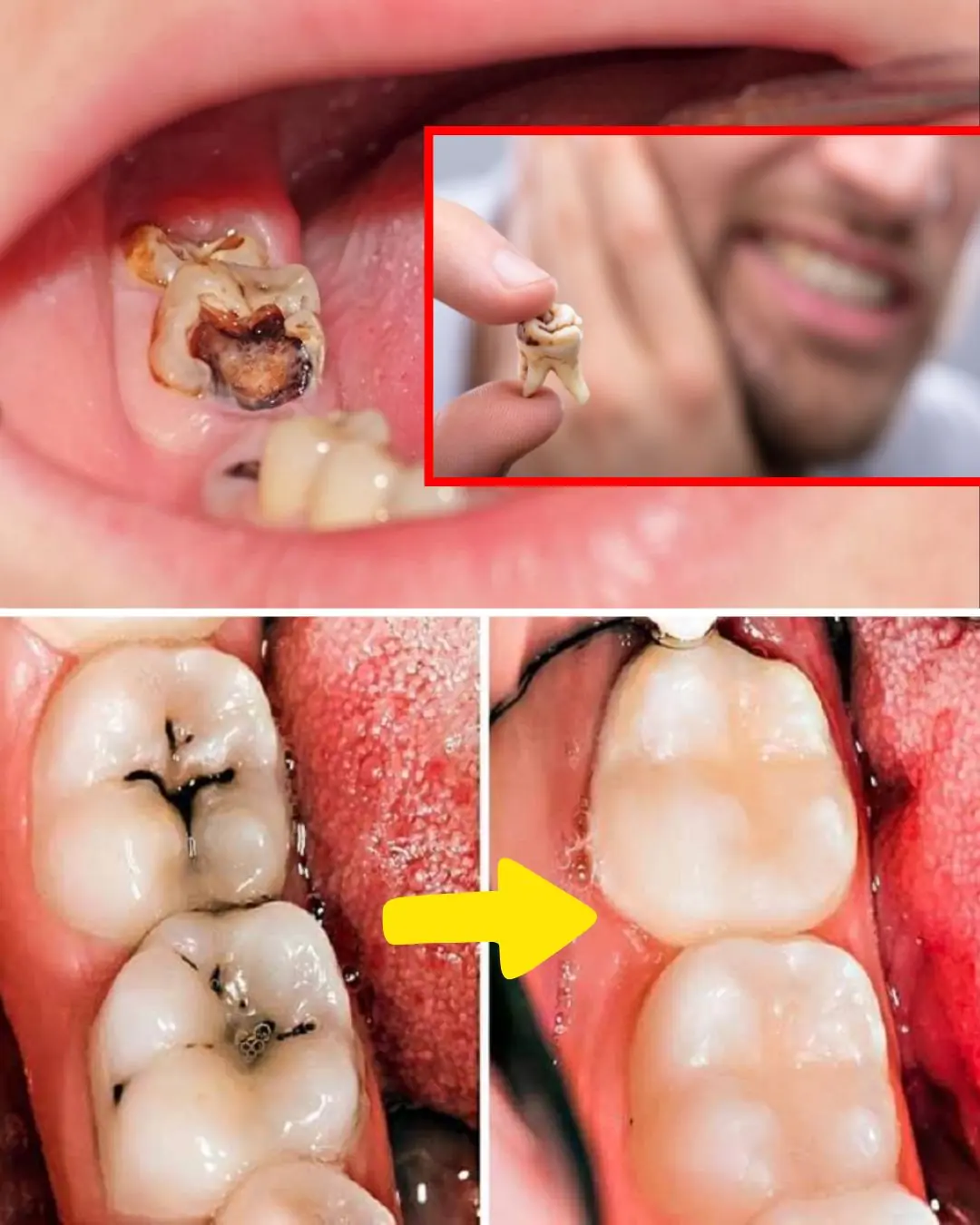 🦷 Understanding Tooth Decay and Remineralization
