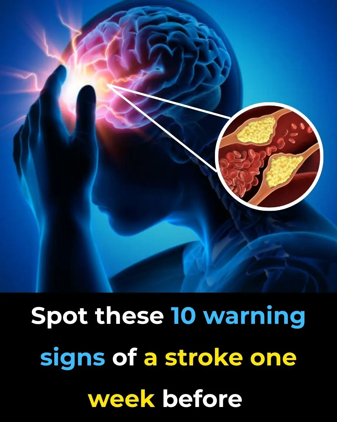 Spot these 10 warning signs of a stroke one week before