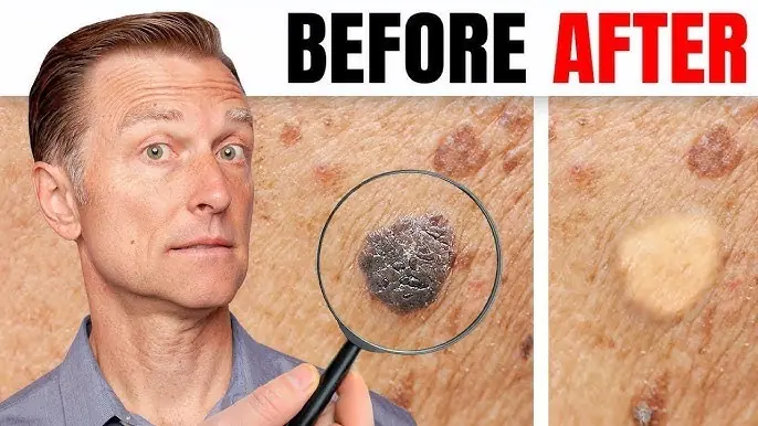 You Won’t Believe How Easy It Is To Get Rid Of Warts And Skin Tags With This Trick