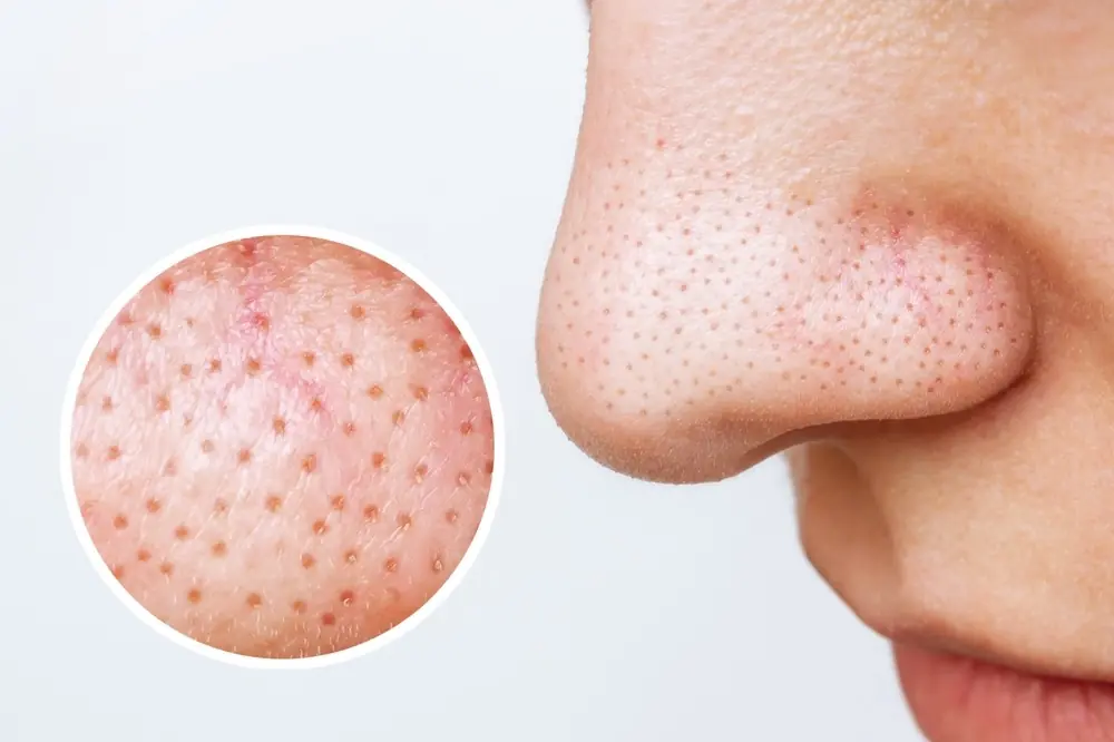 What Are Sebaceous Filaments and Why Are They on Your Face?
