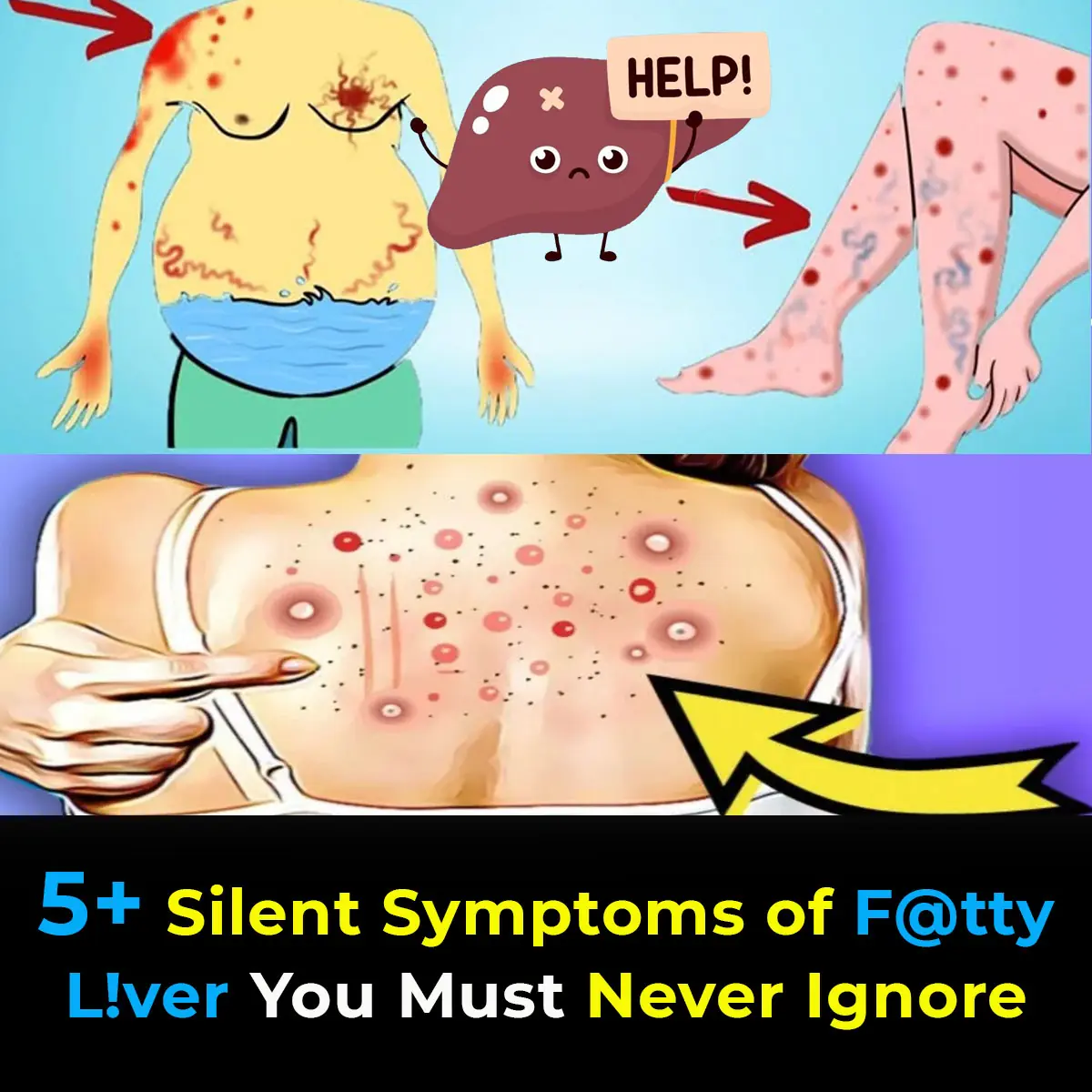 Fatty Liver: Causes, Symptoms, Treatment & Home Remedies