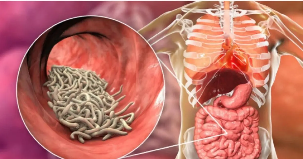 How to Get Rid of Worms and Intestinal Parasites in Humans