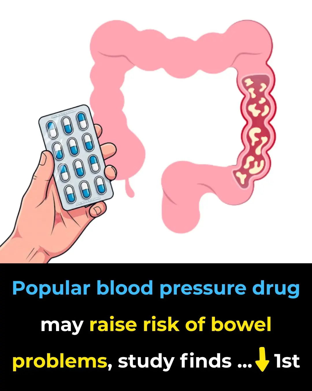 Popular blood pressure drug may raise risk of bowel problems, study finds