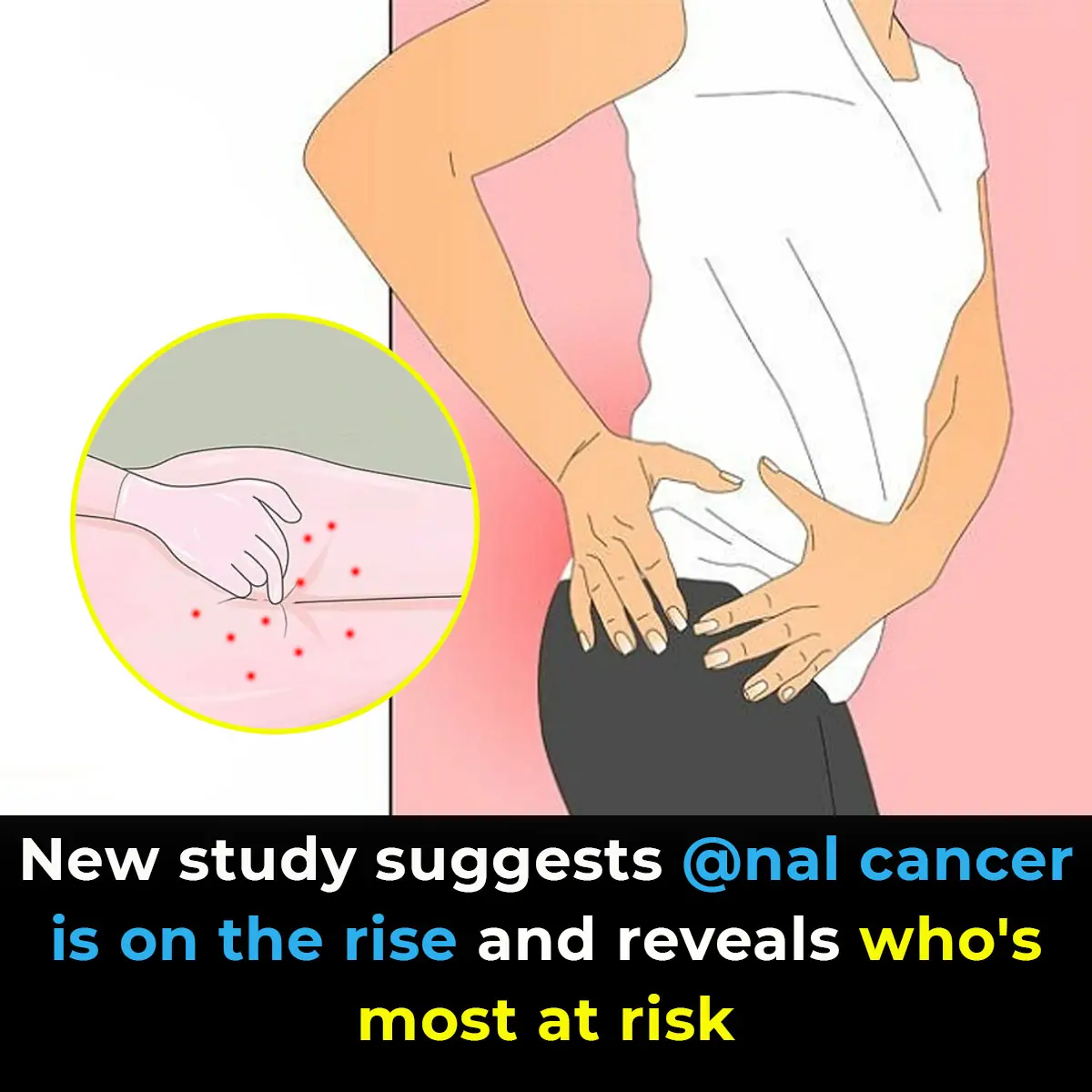 Study suggests anal cancer is on the rise and reveals who’s most at risk