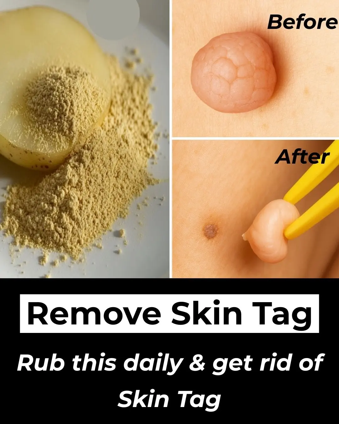 🌿 3 Natural Home Remedies to Remove Skin Tags Safely