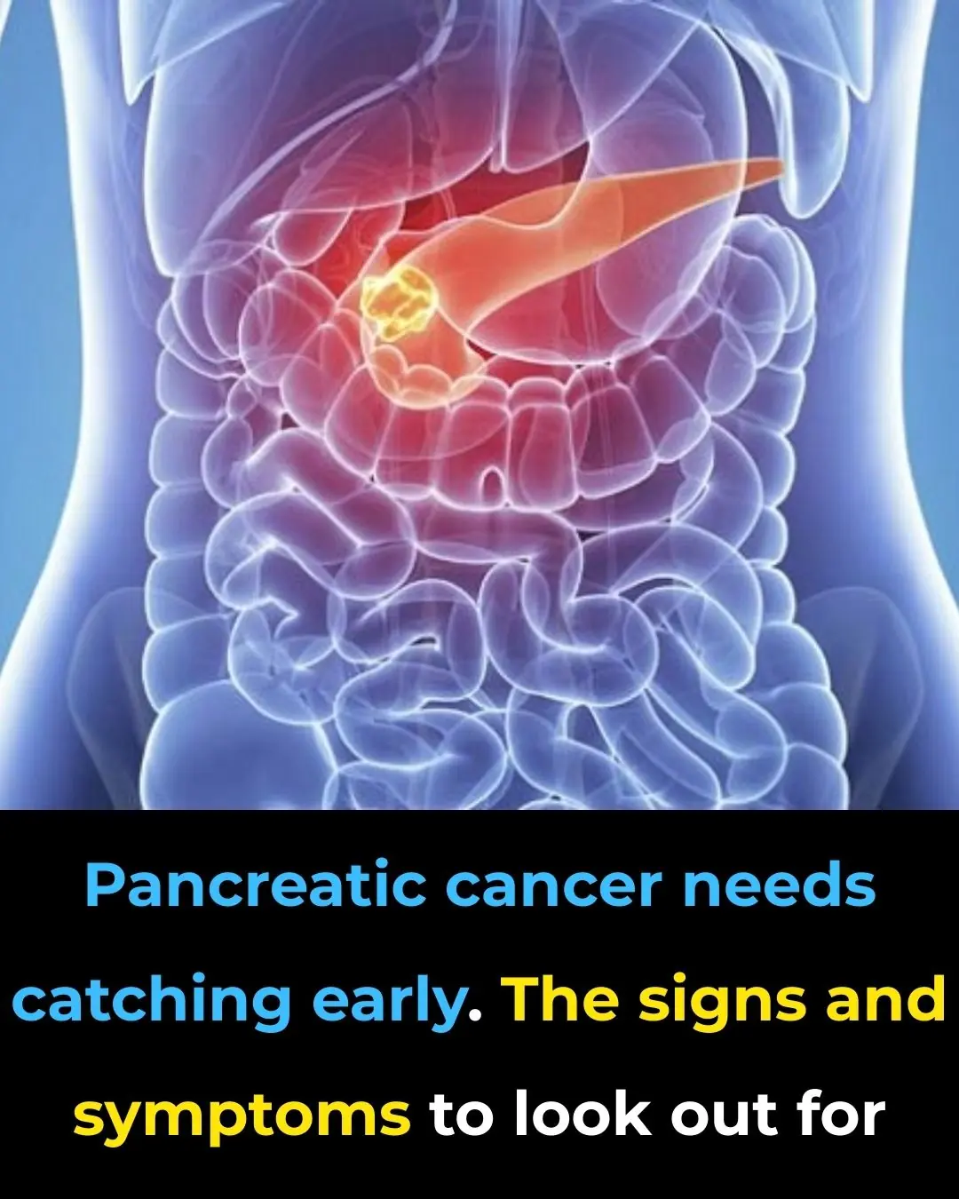 10 Early Signs of Pancreatic Cancer