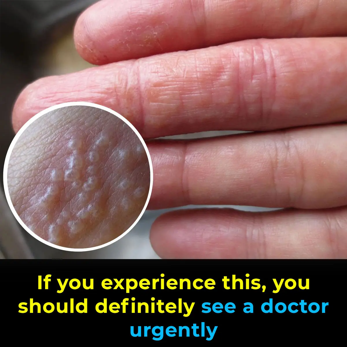If you see these painful red bumps, you may have dyshidrotic eczema