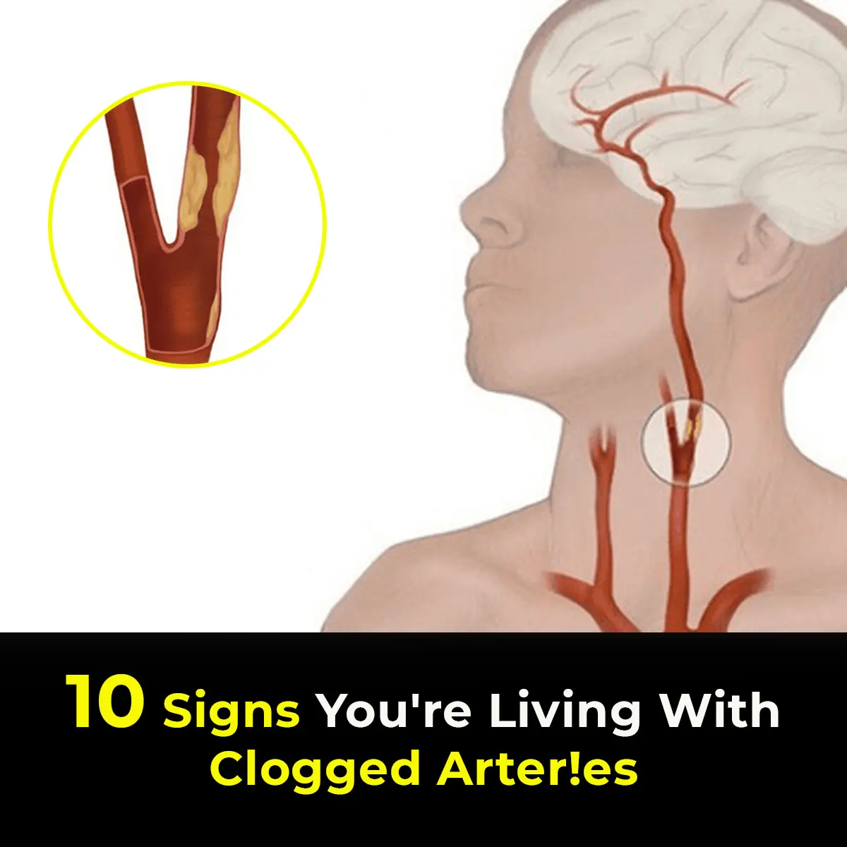 10 Signs You’re Living With Clogged Arteries
