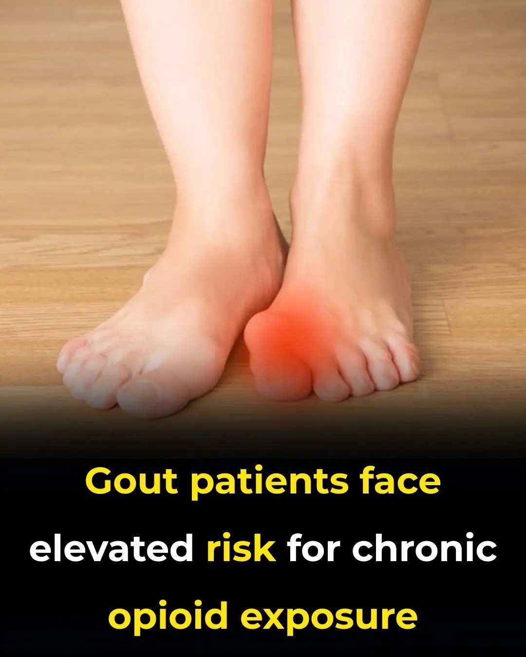 Gout Patients Face Elevated Risk for Chronic Opioid Exposure