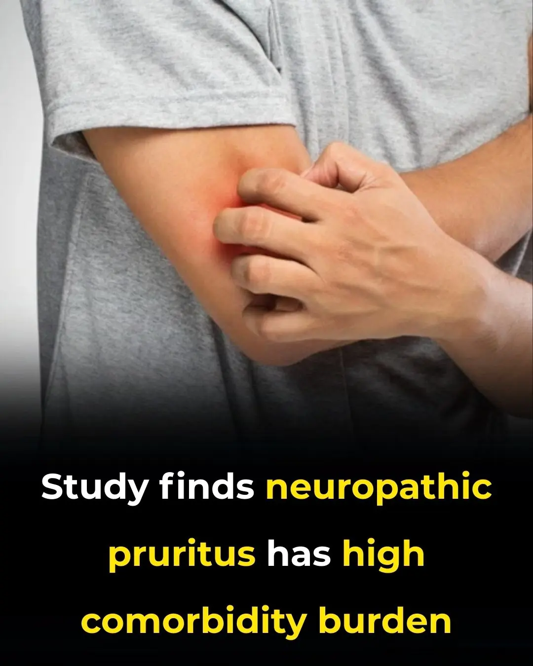Neuropathic Pruritus Has High Comorbidity Burden, Varied Treatment Responses