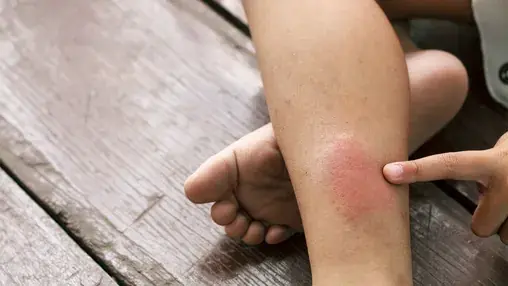 5 Blood Clot Facts Doctors Want You to Know