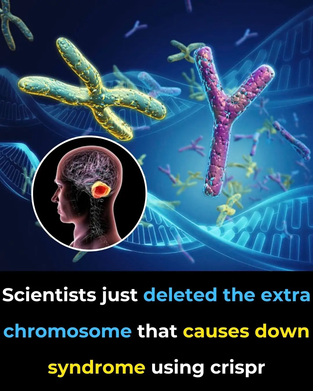 Scientists Just Deleted the Extra Chromosome That Causes Down Syndrome Using CRISPR