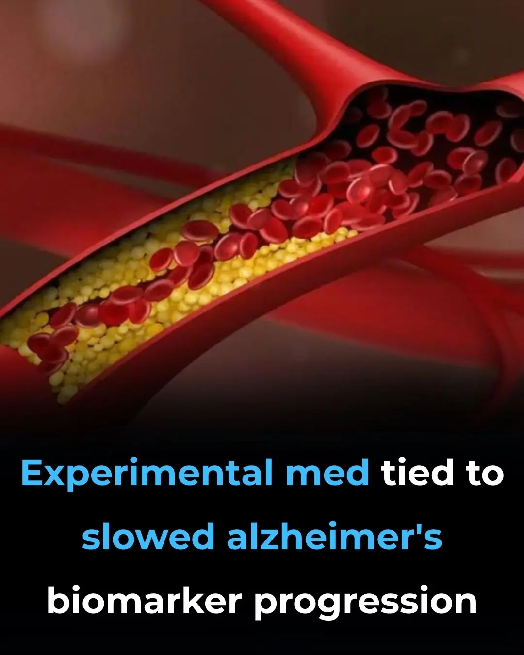 Experimental Med Tied to Slowed Alzheimer’s Biomarker Progression