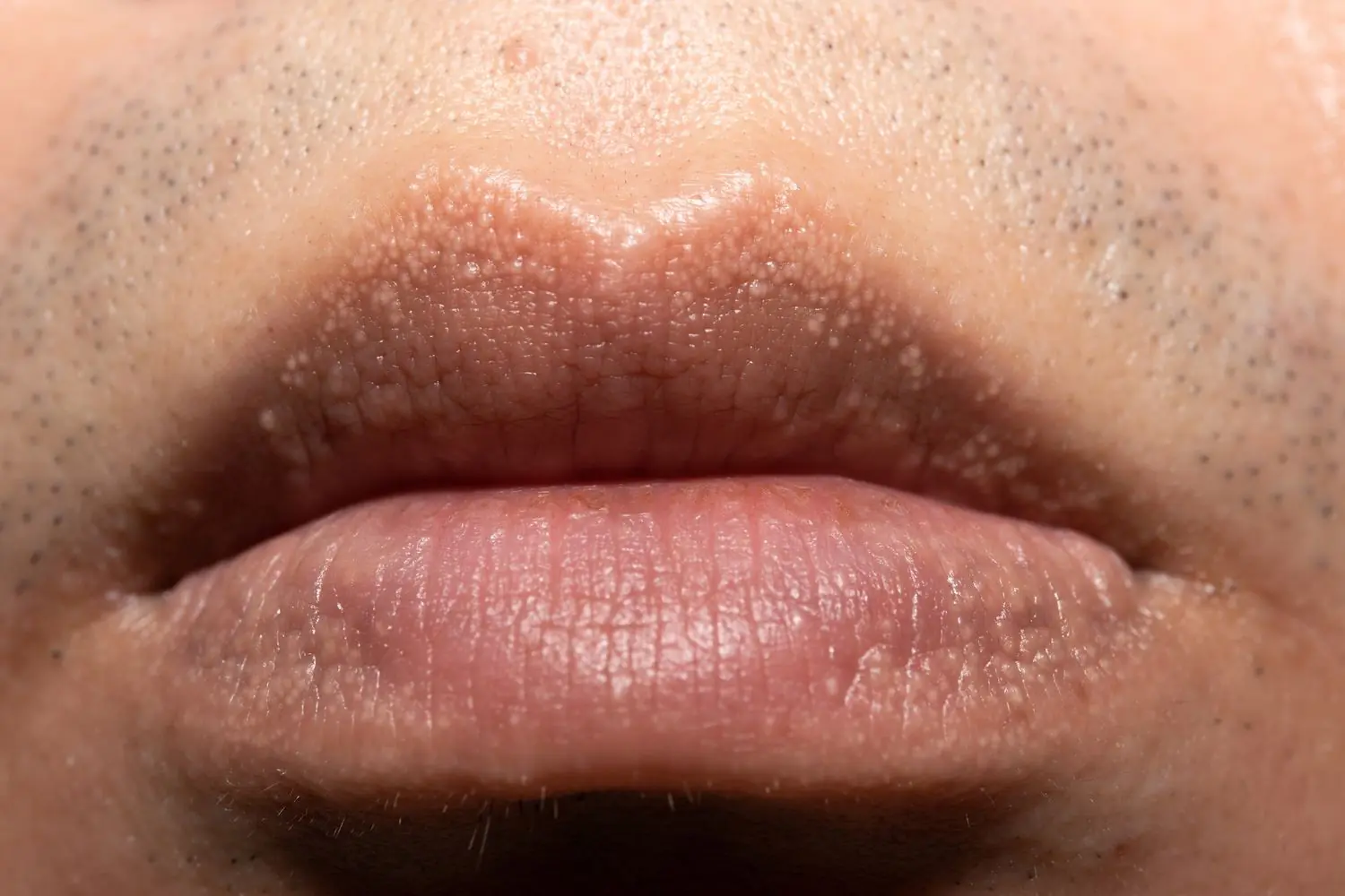 White Bumps on Lips: Causes and Effective Treatments