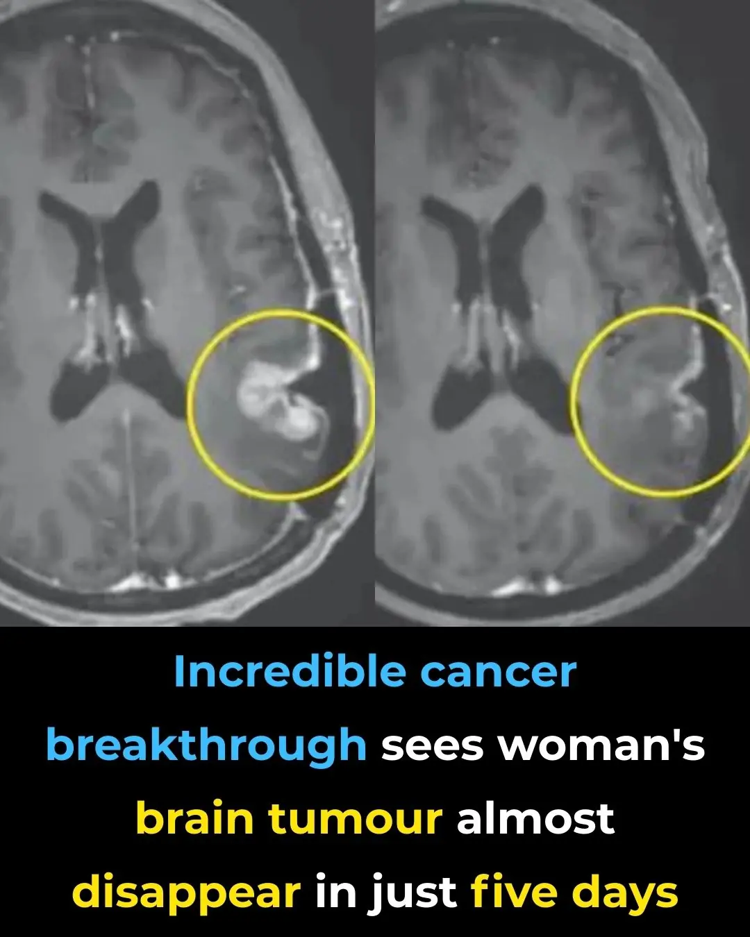 Incredible cancer breakthrough sees woman's brain tumor almost disappear in just five days