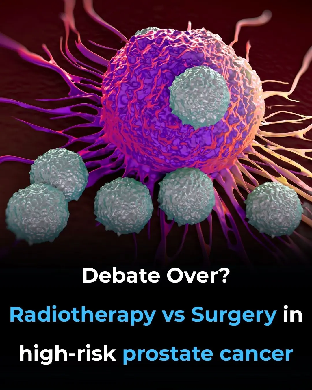 Debate Over? Radiotherapy vs Surgery in High-Risk Prostate Cancer