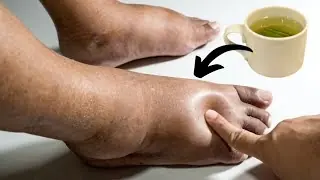 Swollen Legs, Ankles and Feet: Causes and Proven Remedies (Including Parsley Tea Recipe)