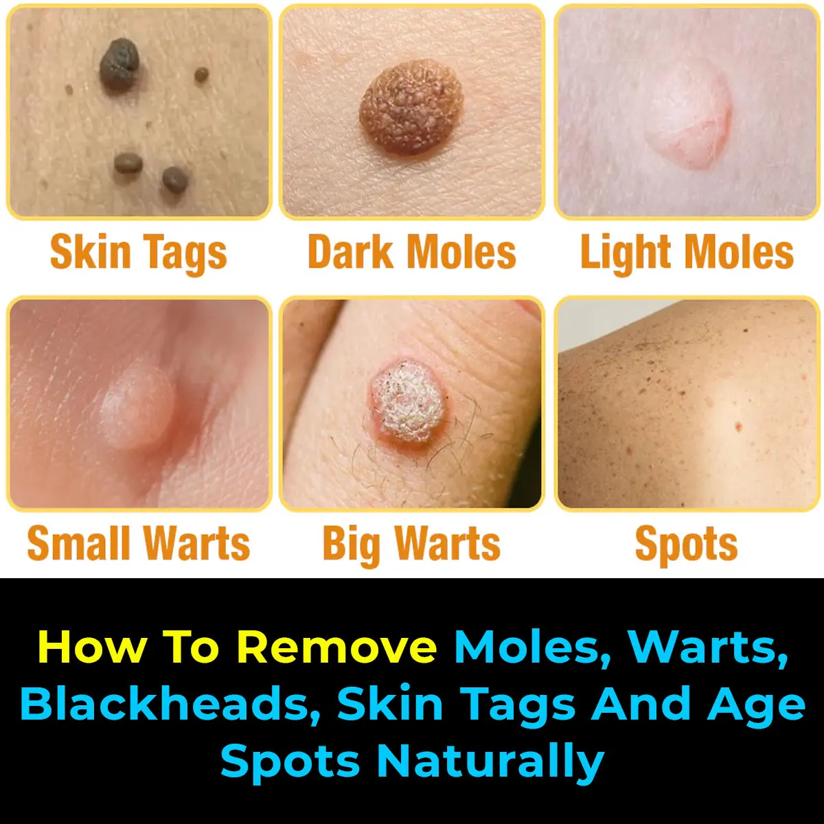 Natural Remedies to Address Skin Tags, Warts, and Blackheads