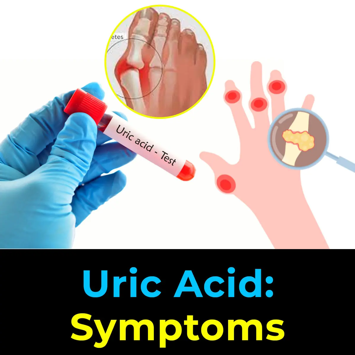 Diet and Uric Acid: Foods to Avoid for Gout Prevention