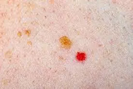 Red Spots on Skin: Causes, Treatments, and More (Extensive Guide)