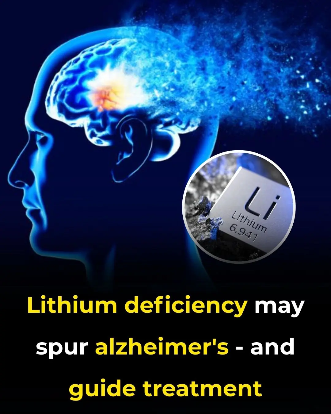Lithium Deficiency May Spur Alzheimer’s — and Guide Treatment