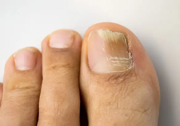 Brittle Nails, Dry Hair? You’re Missing Out on These Vital Vitamins, Says Science!