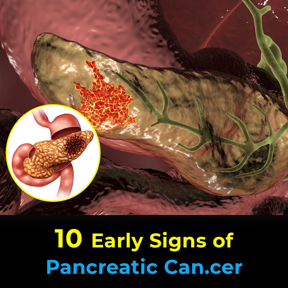 10 Early Signs of Pancreatic Cancer