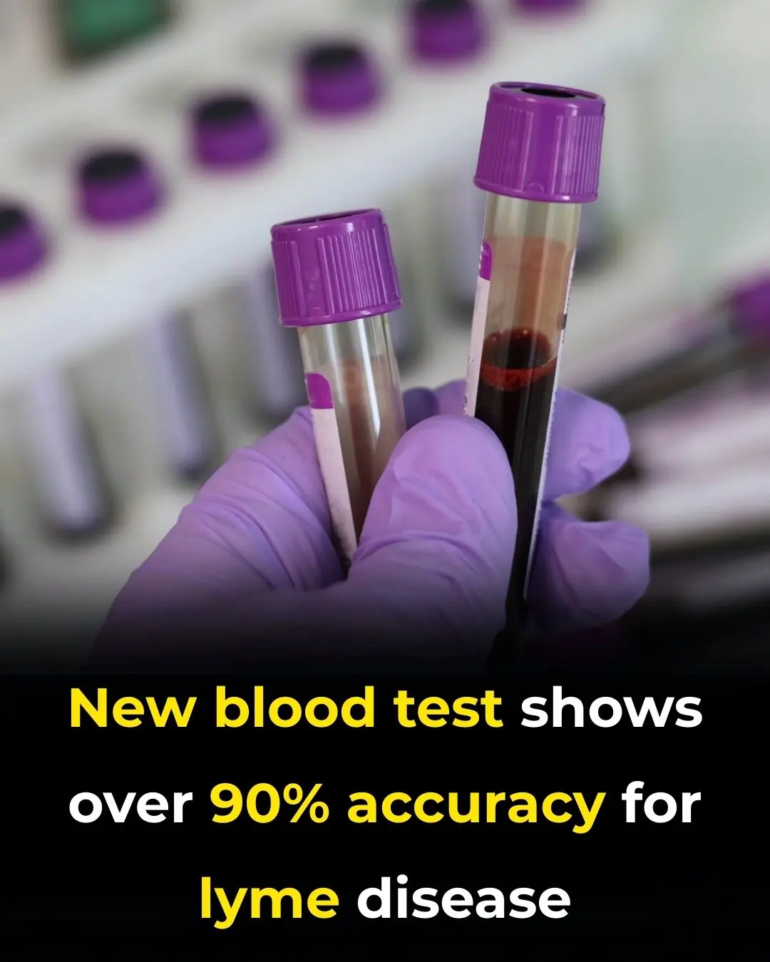 New Blood Test Shows Over 90% Accuracy for Lyme Disease