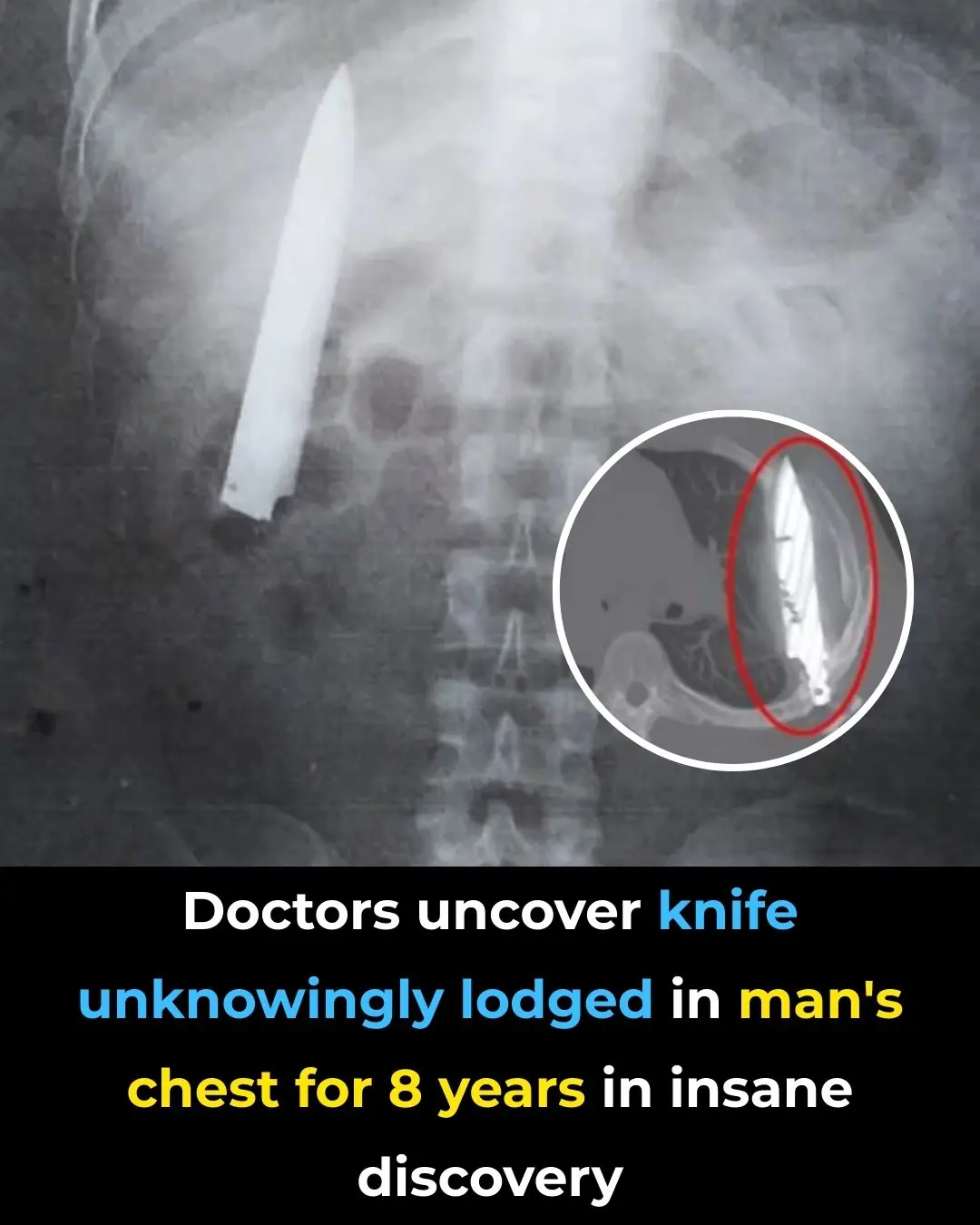 Doctors uncover knife unknowingly lodged in man's chest for 8 years in insane discovery