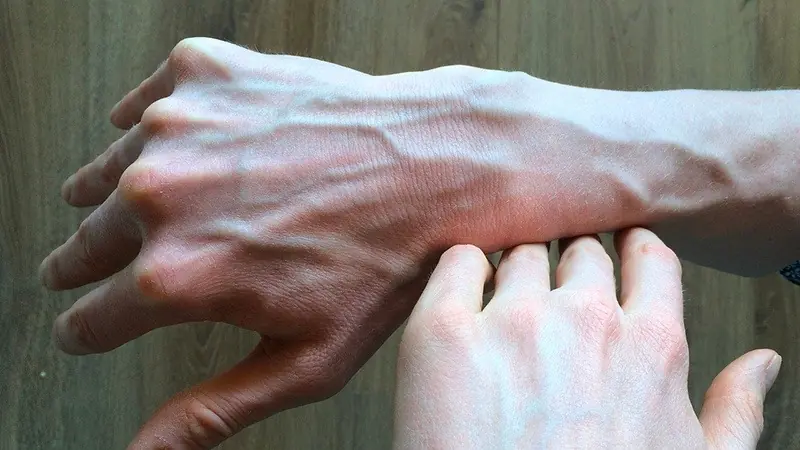 If You See Someone with Prominent Green Veins, Make Sure to Tell Them This – It Could Save Their Life