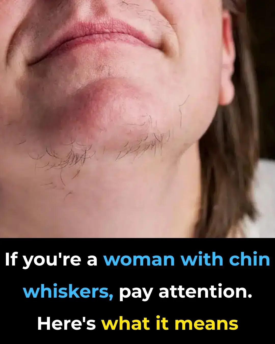 Chin Whiskers in Women