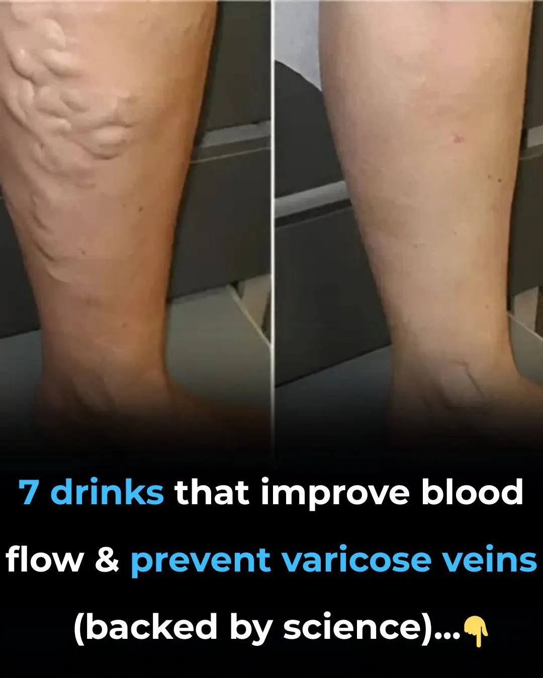 7 Drinks That Improve Blood Flow and Prevent Varicose Veins (Backed By Science)