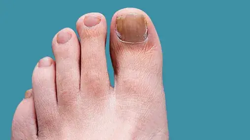 How to Prevent and Treat Toenail and Foot Fungus