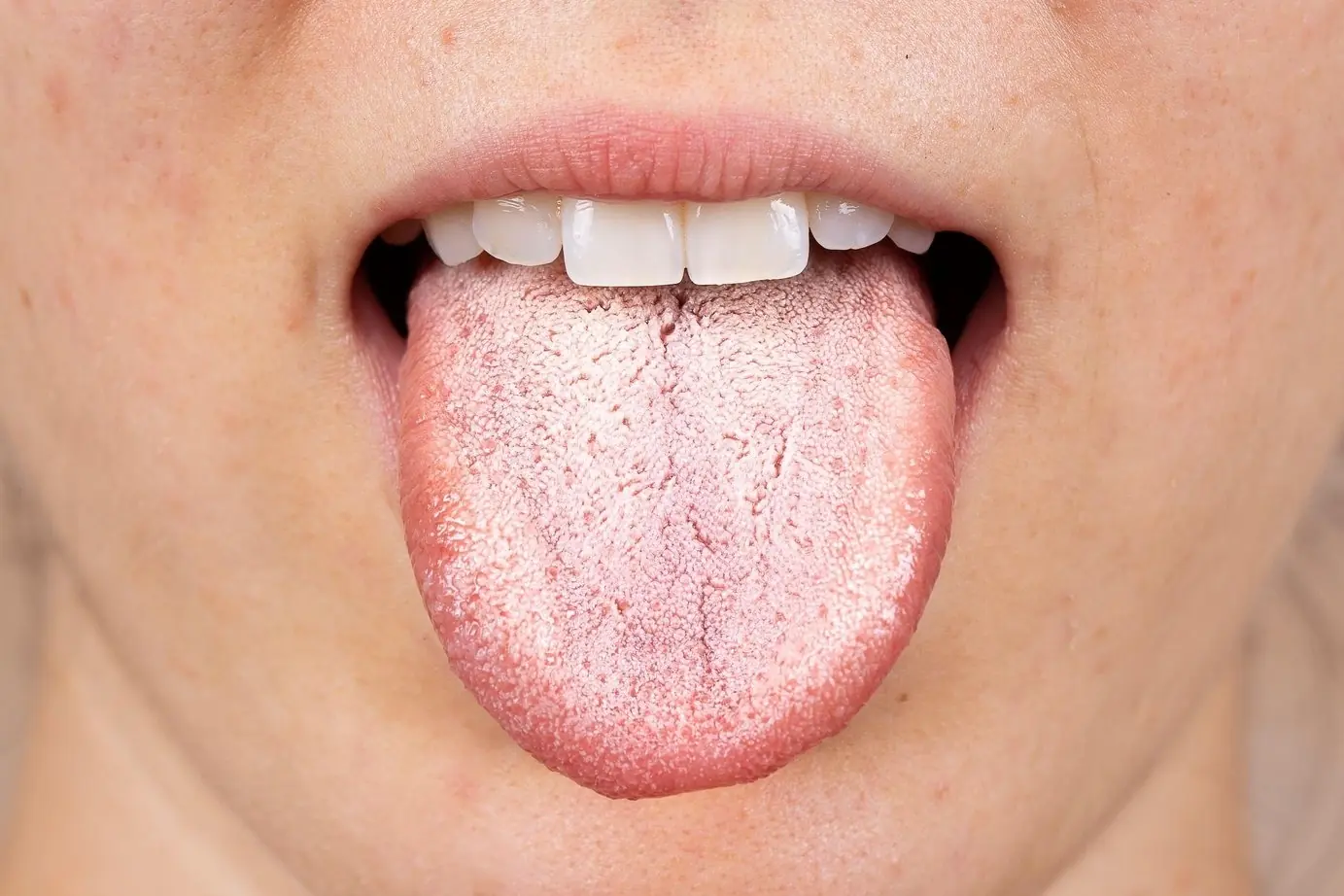 This Hidden Candida Symptom Starts in Your Mouth and Almost Everyone Misses It