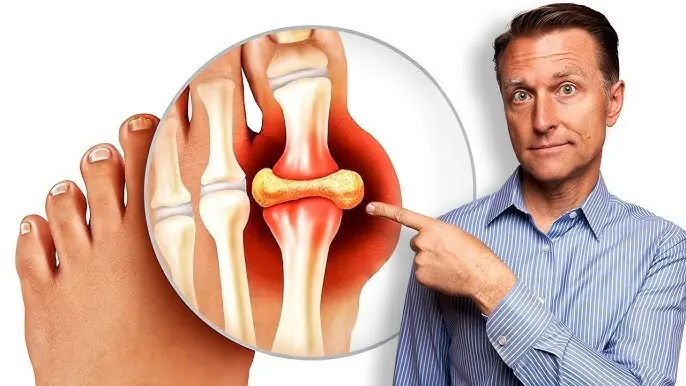 Best Natural Gout Treatments to Remove Uric Acid Crystallization and Prevent Gout And Joint Pain