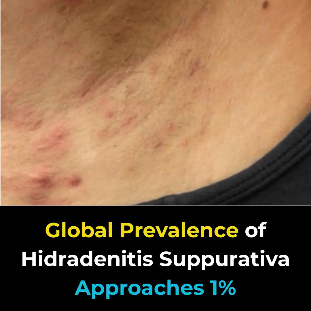 Global Prevalence of Hidradenitis Suppurativa Approaches 1%