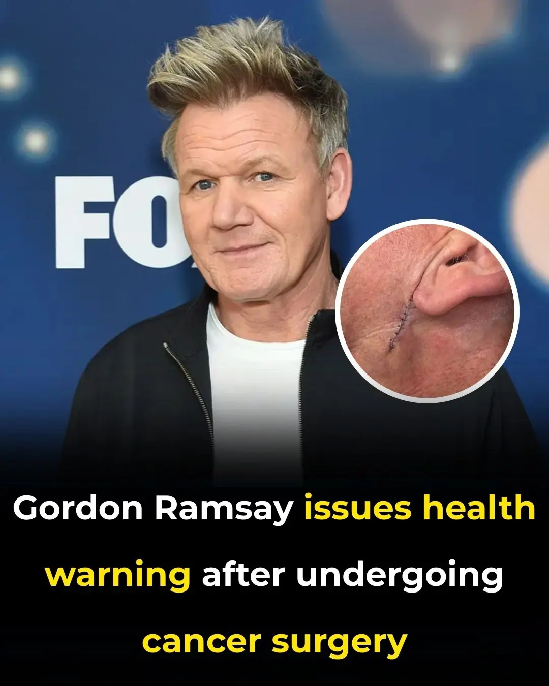 Gordon Ramsay issues health warning after undergoing cancer surgery