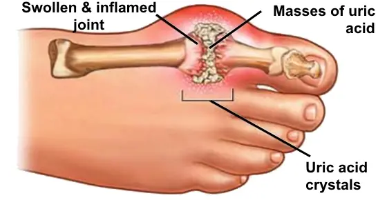 The Best Natural Gout Treatments: Remove Uric Acid Crystallization To Prevent Gout And Joint Pain
